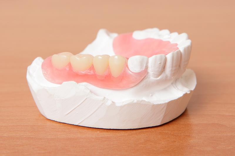 Implant-Supported Bridges Ahwatukee Foothills, AZ